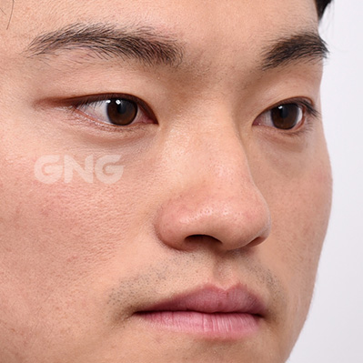성형 전후사진