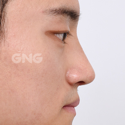 성형 전후사진