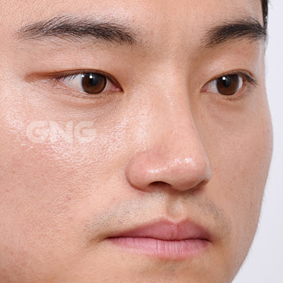 성형 전후사진