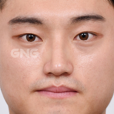 성형 전후사진