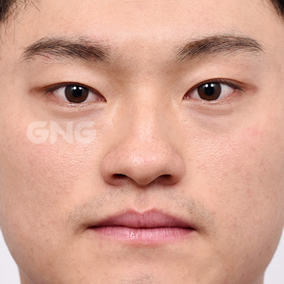 성형 전후사진
