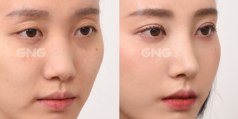 If you want to reduce the nasal spacing before and after compound nose molding