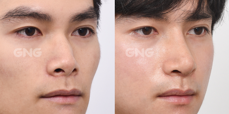 성형 전후사진