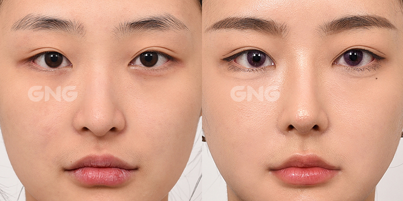 성형 전후사진